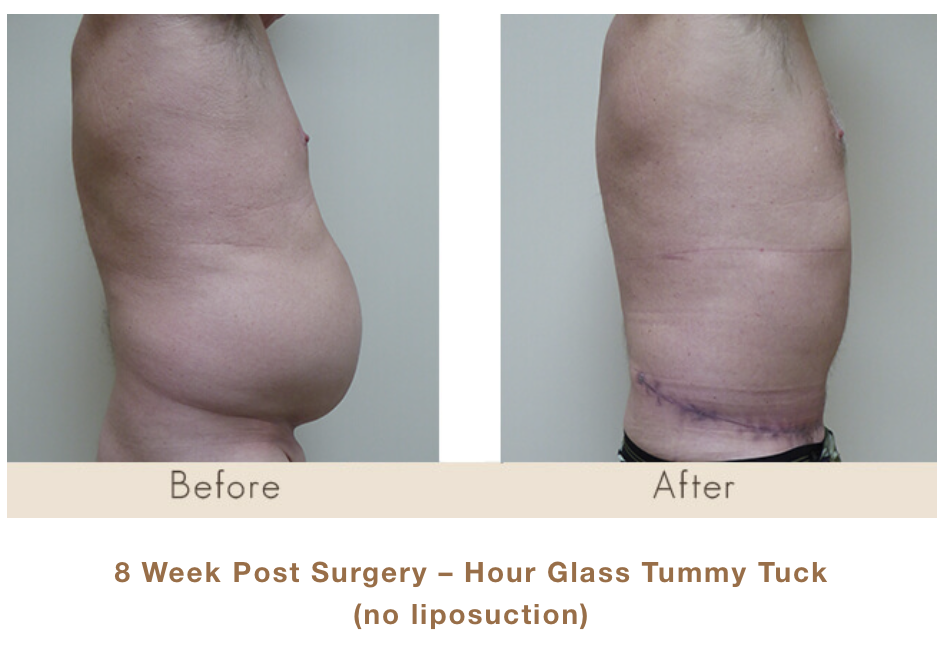 8 weeks post surgery - hourglass tummy tuck (no liposuction)