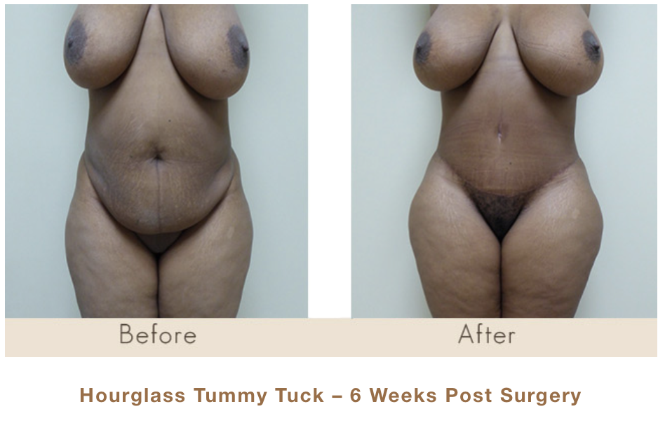 hourglass tummy tuck - 6 weeks post surgery