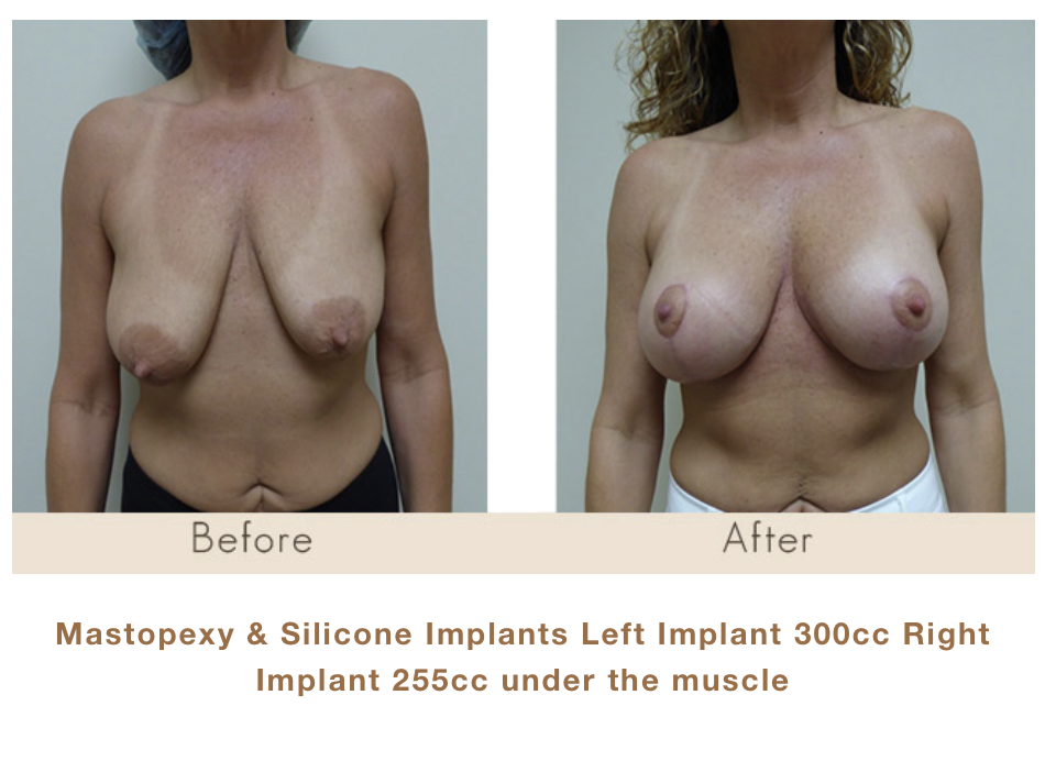 Mastopexy & Silicone Implants