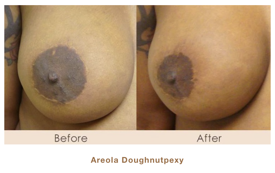 Dr. Michael Gray from Michigan Cosmetic Surgery Center - Areola Doughnutpexy Before and After picture