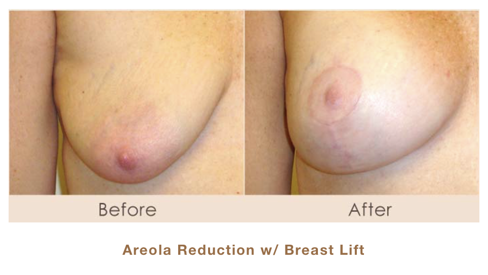 Areola Reduction with Breast Lift