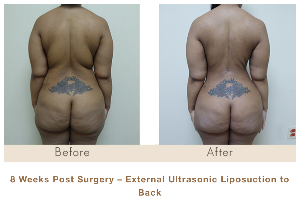 8 Weeks Post Surgery - External Ultrasonic Liposuction of Back by Dr. Michael Gray in Michigan Cosmetic Surgery Center.