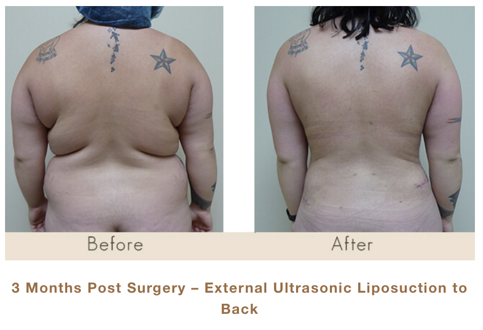 3 Months Post Surgery - External Ultrasonic Liposuction of Back by Dr. Michael Gray in Michigan Cosmetic Surgery Center.