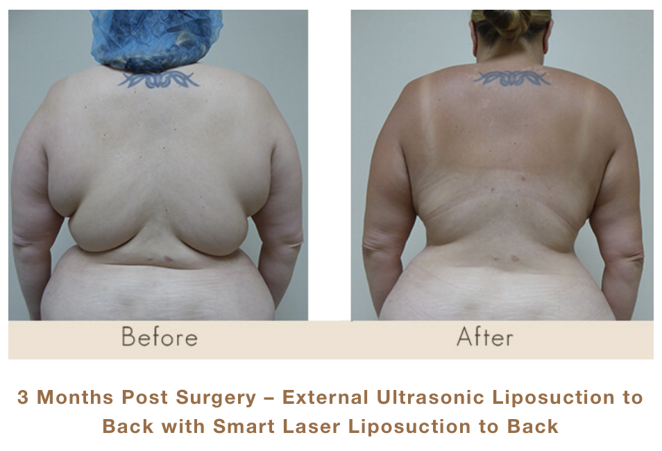 3 Months Post Surgery - External Ultrasonic Liposuction of Back with Smart Laser Liposuction to Back by Dr. Michael Gray in Michigan Cosmetic Surgery Center.