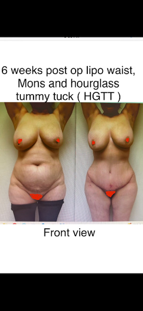 6 Weeks post op Lipo waist, Mons pubis and Hourglass Tummy Tuck (HGTT)
