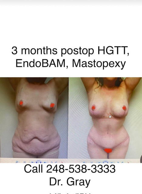 3 months postop HGTT, EndoBAM, Mastopexy