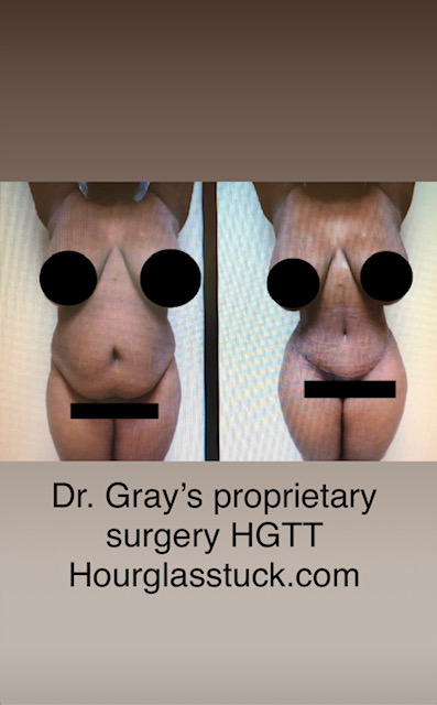Dr. Gray's Proprietary Surgery HGTT. Hourglasstuck.com 