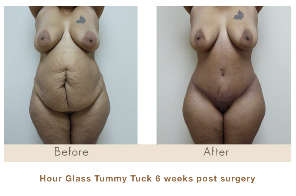 Hour Glass Tummy Tuck 6 weeks post surgery by Dr. Michael W. Gray.
