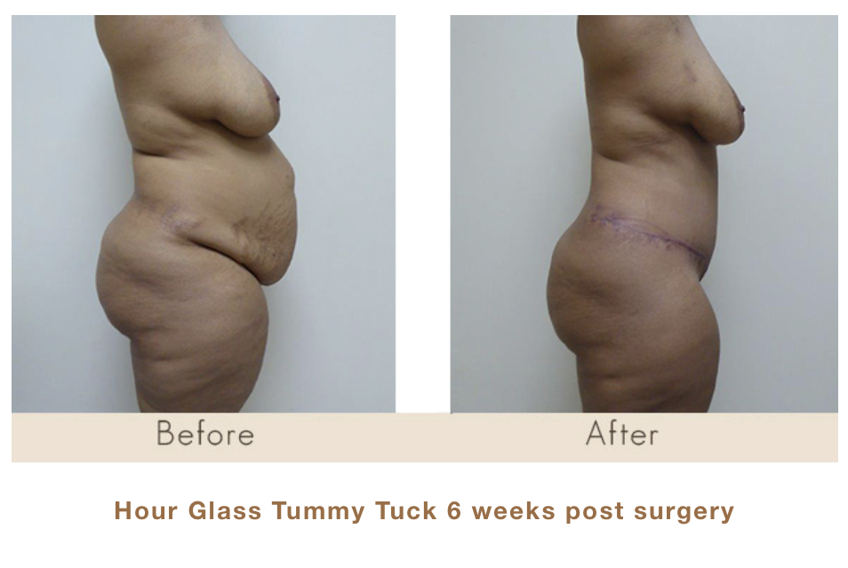 Hour Glass Tummy Tuck 6 weeks post surgery by Dr. Michael W. Gray.
