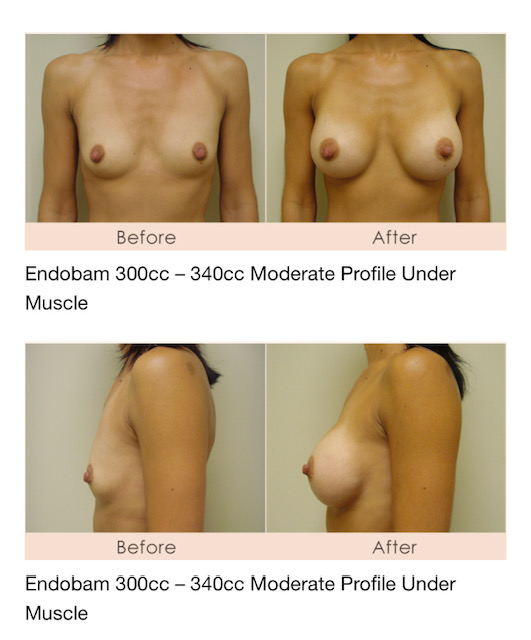 Breast augmentation in Michigan by Dr. Michael W. Gray from Michigan Cosmetic Surgery Center and Skin Deep Spa.