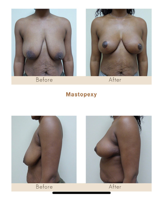 Mastopexy. Breast augmentation in Michigan by Dr. Michael W. Gray from Michigan Cosmetic Surgery Center and Skin Deep Spa.
