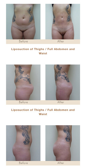 Liposuction of thighs and full abdomen in Michigan by Dr. Michael W. Gray from Michigan Cosmetic Surgery Center and Skin Deep Spa.