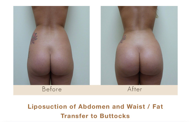 Liposuction of abdomen, waist and fat transfer/BBL in Michigan by Dr. Michael W. Gray from Michigan Cosmetic Surgery Center and Skin Deep Spa.