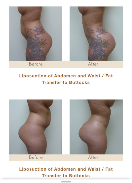 Liposuction of abdomen, waist and fat transfer/BBL in Michigan by Dr. Michael W. Gray from Michigan Cosmetic Surgery Center and Skin Deep Spa.
