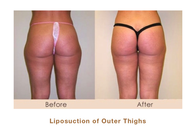 Liposuction of outer thighs in Michigan by Dr. Michael W. Gray from Michigan Cosmetic Surgery Center and Skin Deep Spa.