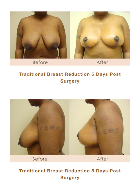 Traditional breast reduction in Michigan by Dr. Michael W. Gray from Michigan Cosmetic Surgery Center and Skin Deep Spa.