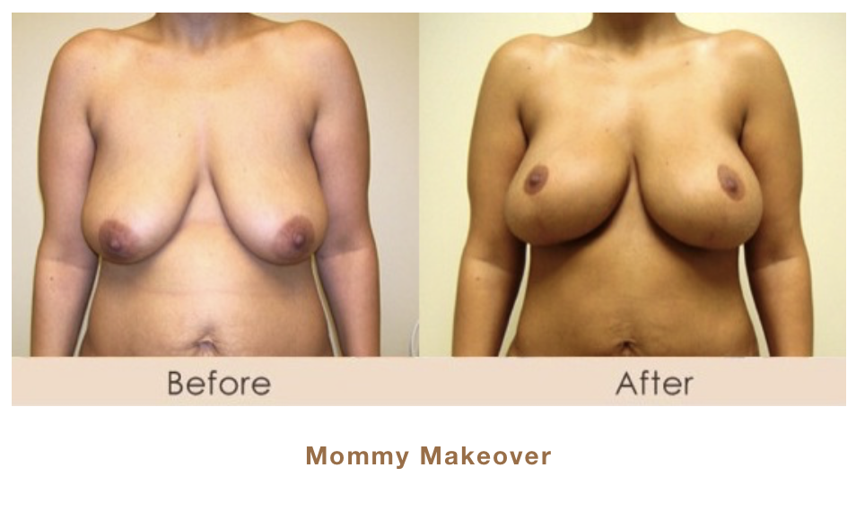 Mommy Makeover in Michigan by Dr. Michael W. Gray from Michigan Cosmetic Surgery Center and Skin Deep Spa.