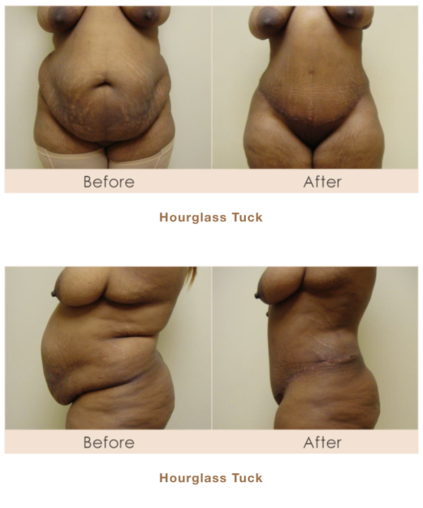 Hourglass Tuck in Michigan by Dr. Michael W. Gray from Michigan Cosmetic Surgery Center and Skin Deep Spa.
