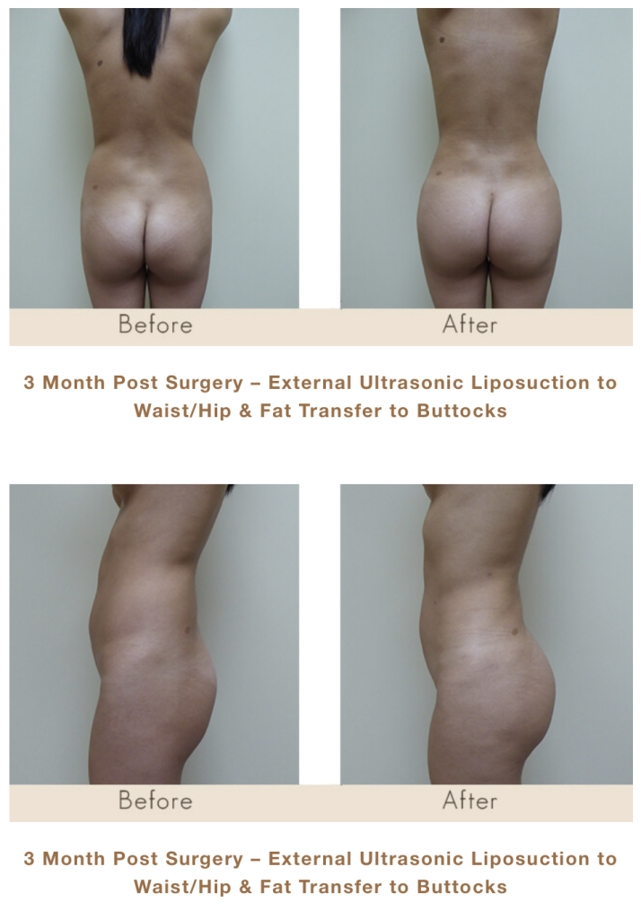 Fat Transfer to Buttocks and Liposuction of Waist/Hip in Michigan by Dr. Michael W. Gray from Michigan Cosmetic Surgery Center and Skin Deep Spa.