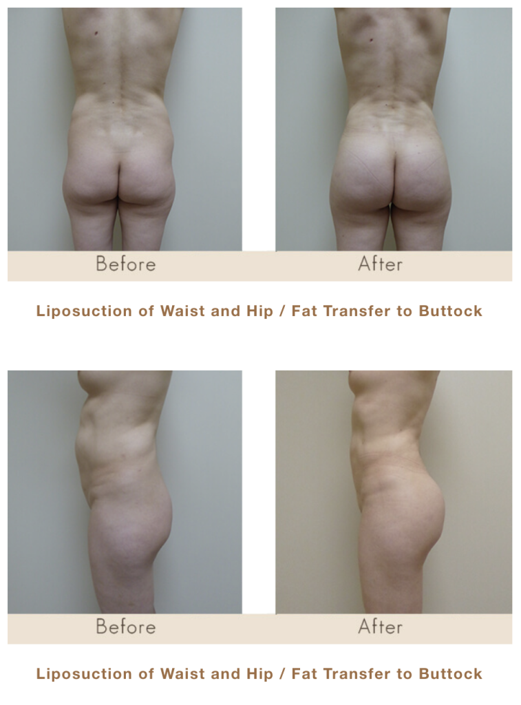 Fat Transfer to Buttocks and Liposuction of Waist in Michigan by Dr. Michael W. Gray from Michigan Cosmetic Surgery Center and Skin Deep Spa.