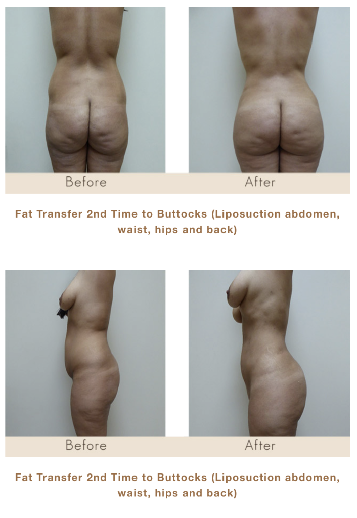 Fat Transfer to Buttocks and Liposuction in Michigan by Dr. Michael W. Gray from Michigan Cosmetic Surgery Center and Skin Deep Spa.