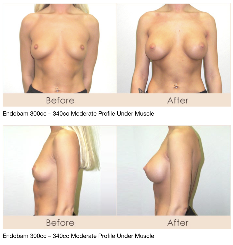 Scarless breast lift in Michigan. Dr. Michael W. Gray from Michigan Cosmetic Surgery Center and Skin Deep Spa. 