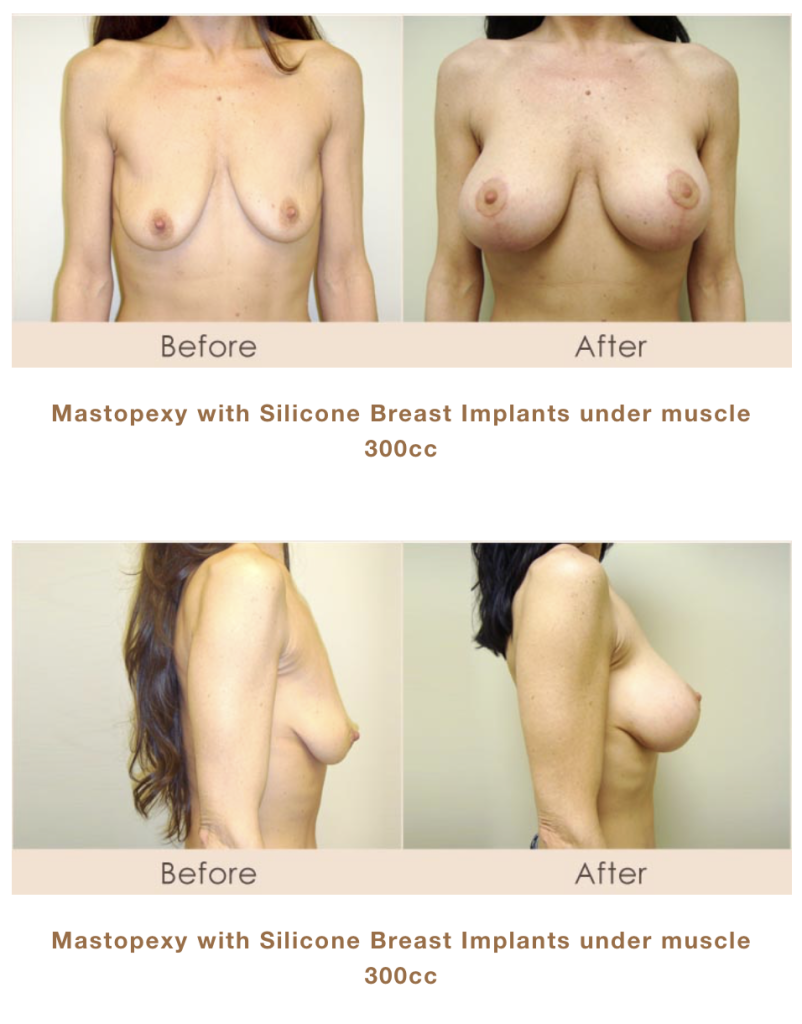 Breast lift, mastopexy and silicone implants in Michigan. Dr. Michael W. Gray from Michigan Cosmetic Surgery Center and Skin Deep Spa. 