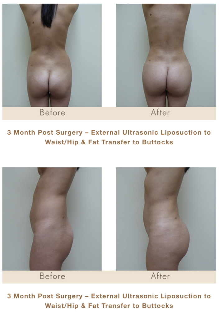 3 Month Post Surgery. Brazilian Butt Lift Surgery in Michigan with Fat Transfer.