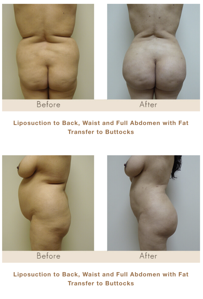 Liposuction to the Back, Waist and Abdomen. Brazilian Butt Lift Surgery in Michigan with Fat Transfer.