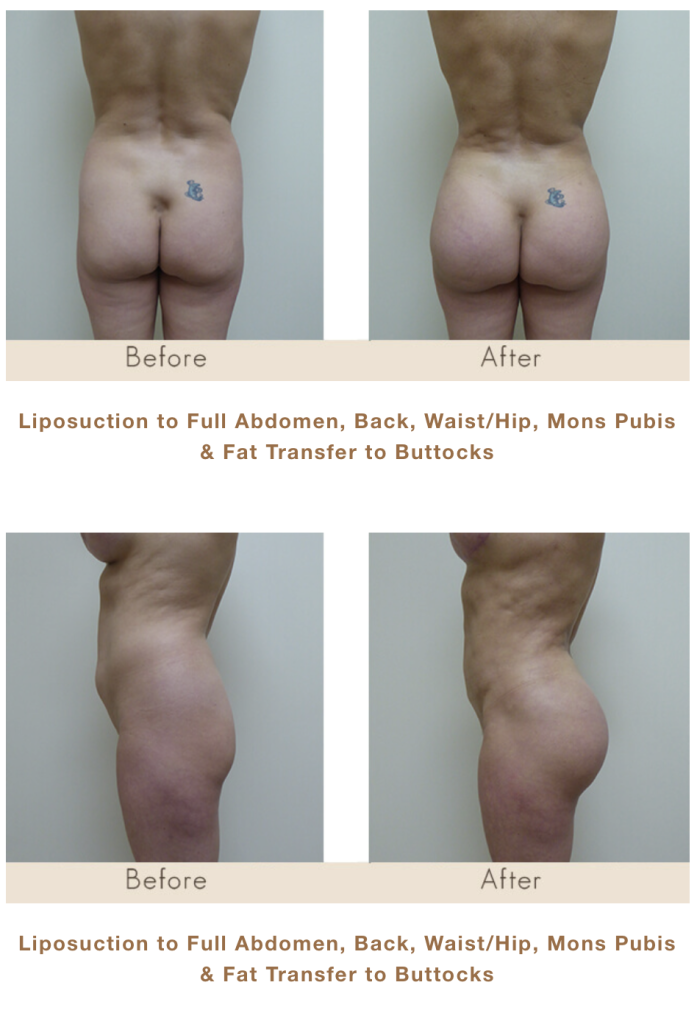 Liposuction to the Back, Waist, Mons Pubis, and Abdomen. Brazilian Butt Lift Surgery in Michigan with Fat Transfer.
