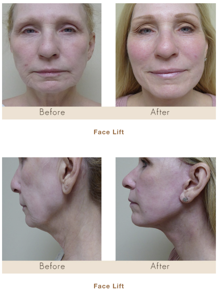 Traditional Facelift before and after picture in Michigan
