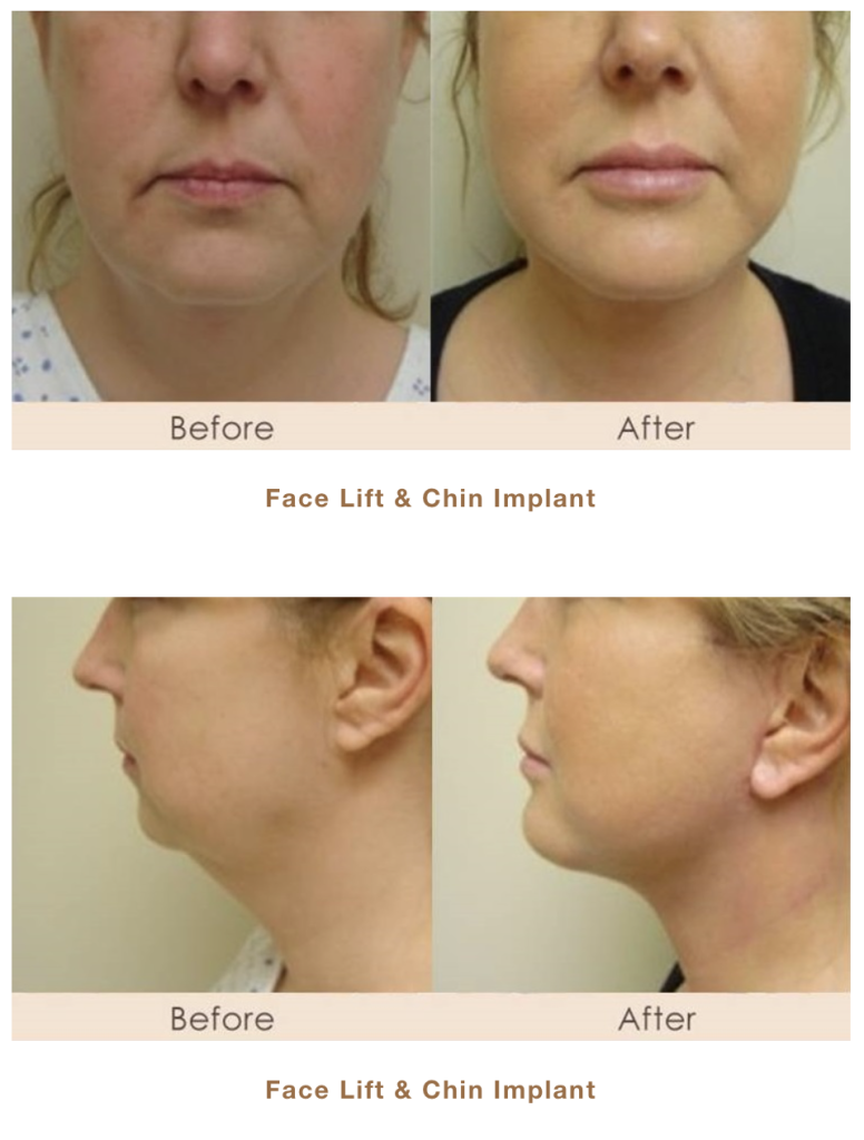 Traditional Facelift & Chin Implant before and after picture in Michigan