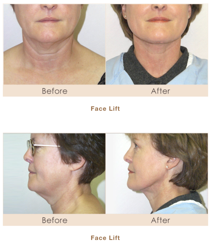 Traditional Facelift before and after picture in Michigan