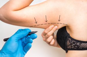 What to Expect with Arm Tuck procedures vs Lipo- Reduction: Recovery, Scars, and Real Results