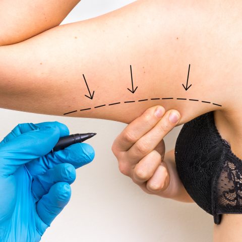 What to Expect with Arm Tuck procedures vs Lipo- Reduction: Recovery, Scars, and Real Results