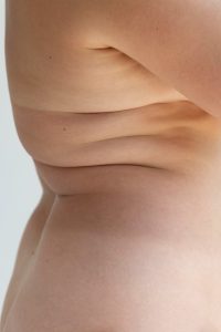 Fat Transfer - A New You