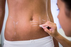 Hi-Def Liposuction & Ab Sculpting - A New You