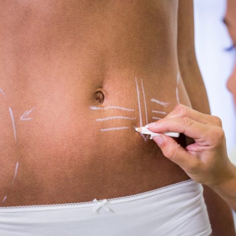 Hi-Def Liposuction & Ab Sculpting - A New You