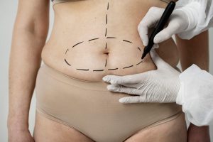 Tummy Tuck Surgery - A New You