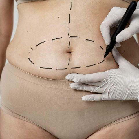 Tummy Tuck Surgery - A New You